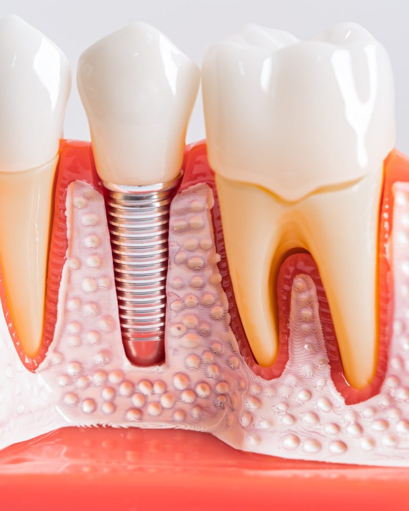 Dental implant, artificial tooth roots into jaw, root canal of dental treatment, gum disease